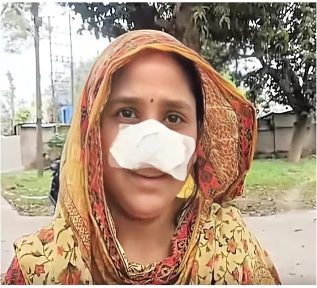 అందంగా ఉందని భార్య ముక్కు కొరికేసిన భర్త